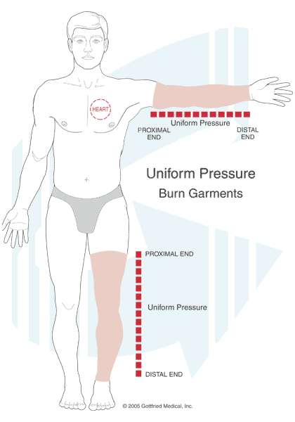 Custom Burn Pressure Garments by Compression Management Services